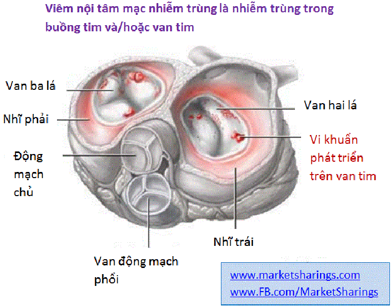 Infective endocarditis - Hình ảnh minh họa
